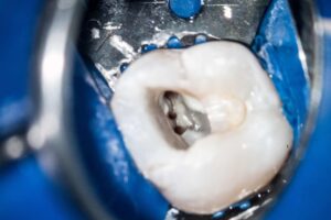 Microscope-Based Endodontics: A Leap in Precision and Perfection