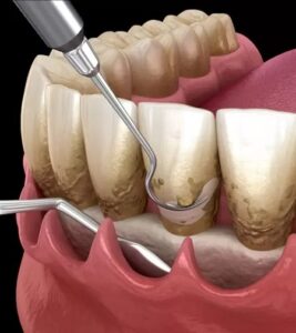 Flap Surgery in Dentistry: Everything You Need to Know About Why, Procedure, Recovery, and Benefits